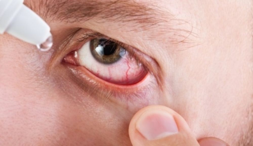 بعض العلاجات الطبيعية لمن يعاني من مشكلة احمرار العيون.