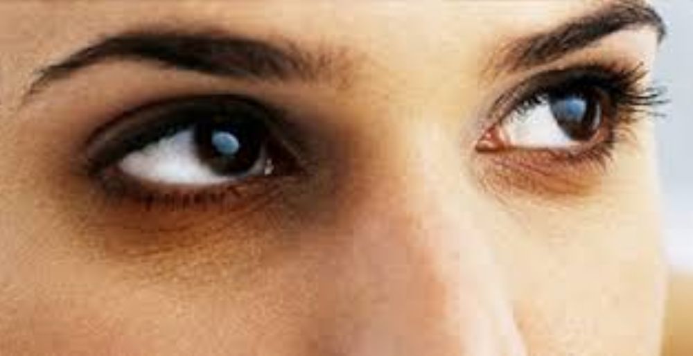 ملف كامل عن الهالات السوداء حول العين وعلاجها بالطب البديل والاعشاب